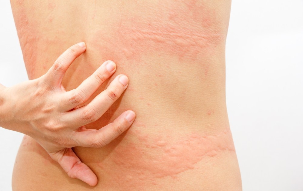 Giải Pháp Để Quần Áo Nhanh Khô Trong Những Ngày Mưa Kéo Dài 3 Gây phát ban, mẩn ngứa da